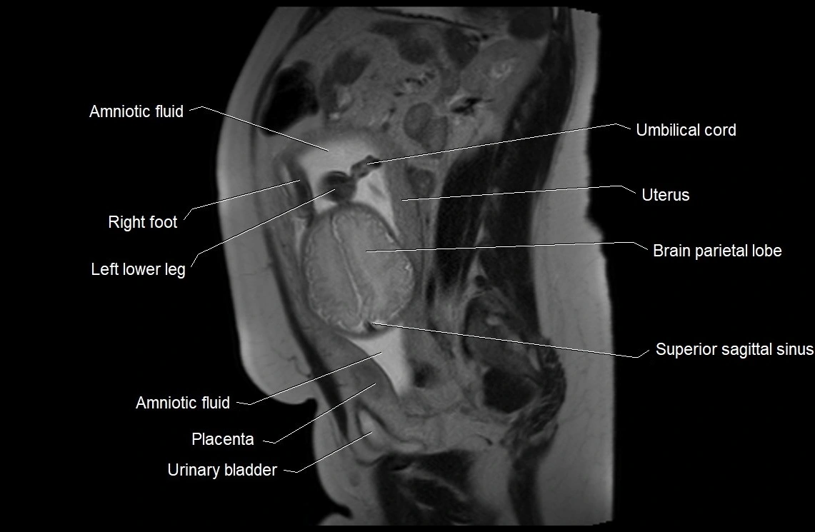 MRI fetal anatomy sagittal image 24.webp